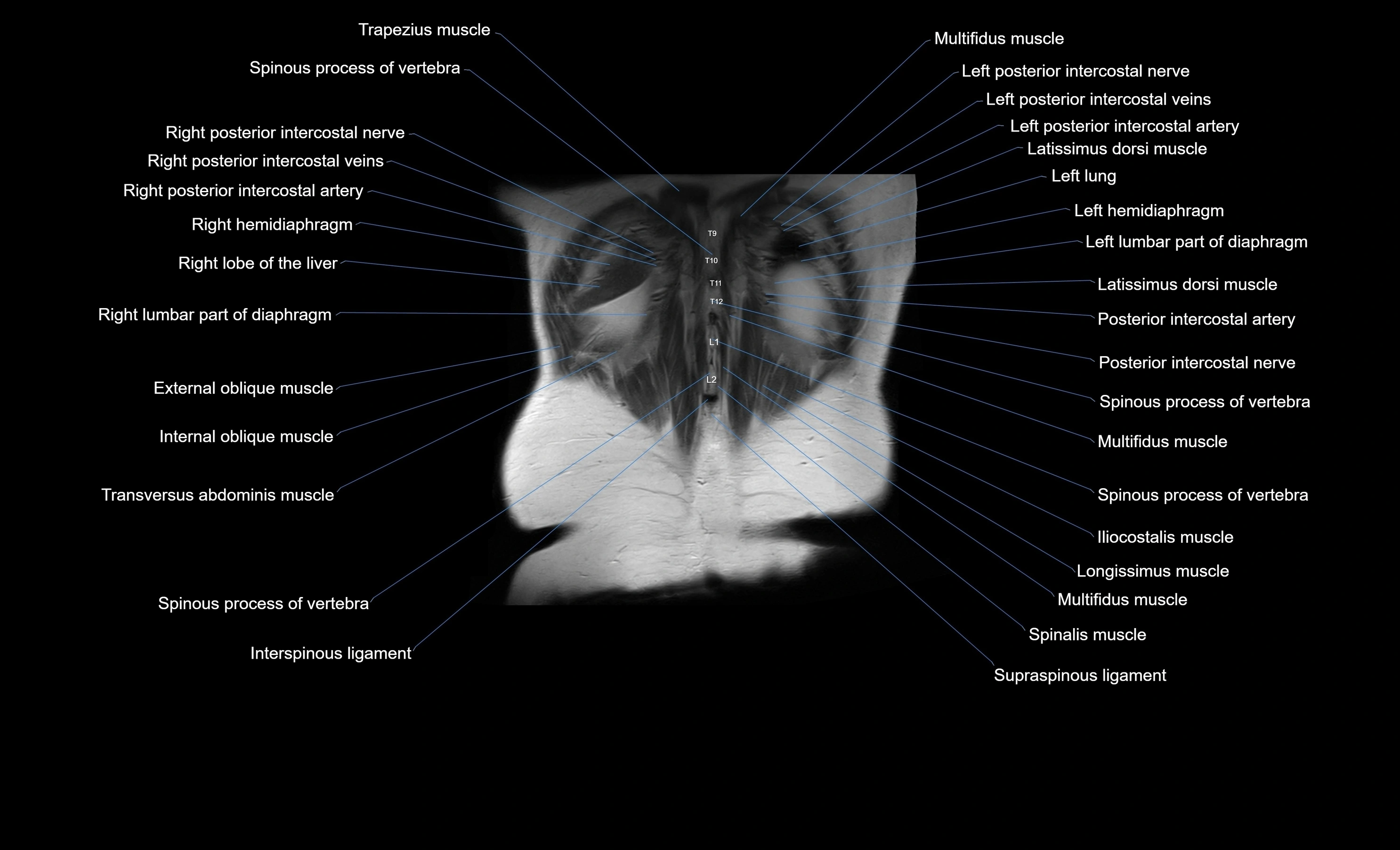 MRI Abdomen coronal labelled cross sectional anatomy radiology  image-img-00001-00053.webp